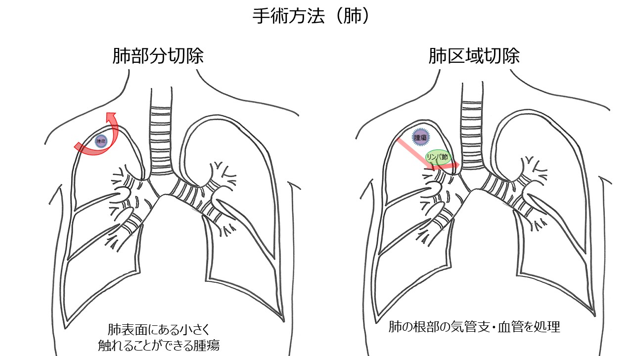 過誤腫の見通しはどうなりますか?