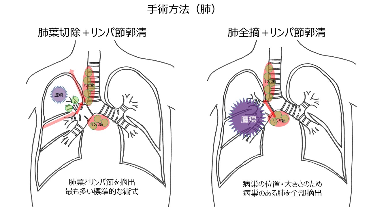 過誤腫の治療