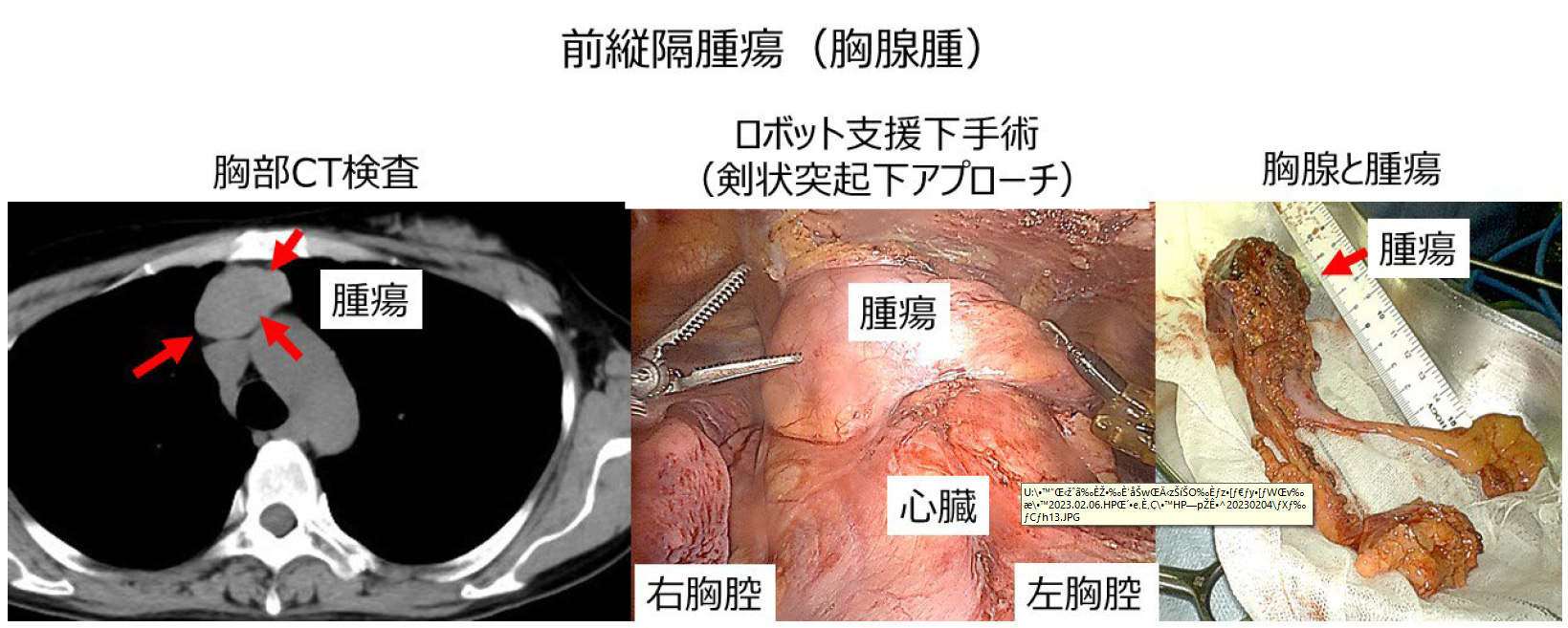 前縦隔腫瘍（胸腺腫）