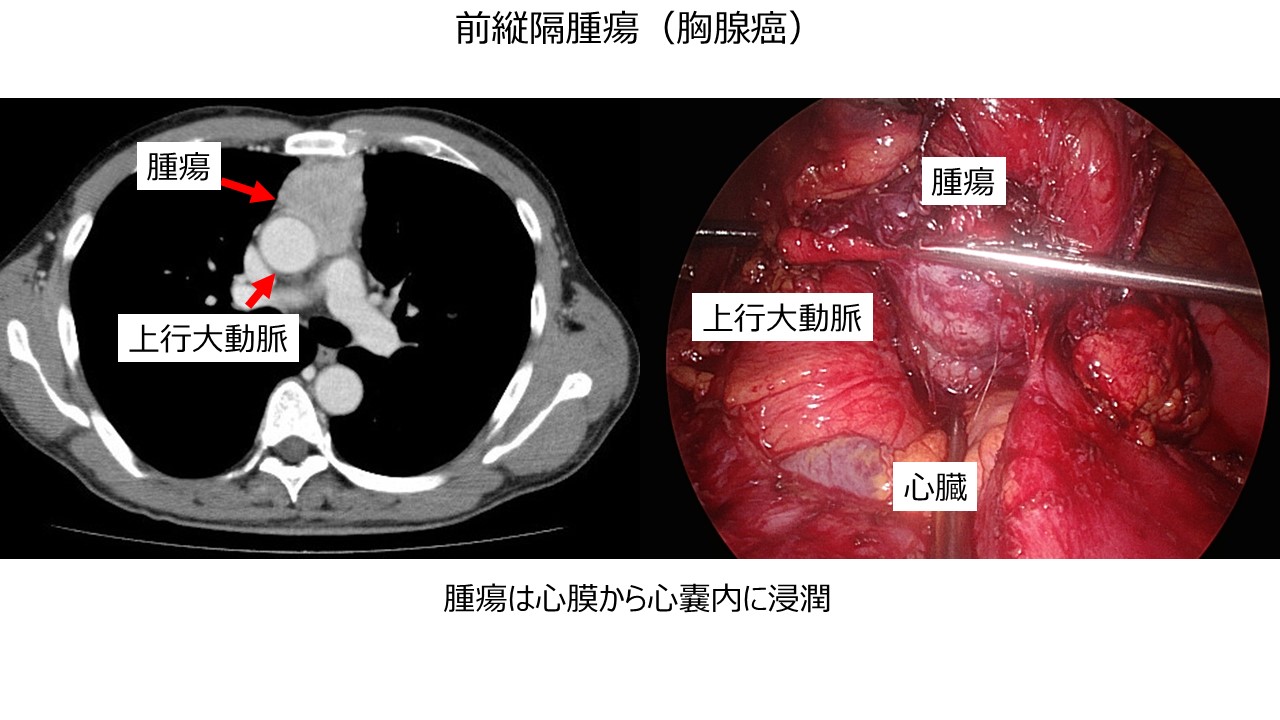 前縦隔腫瘍（胸腺腫）