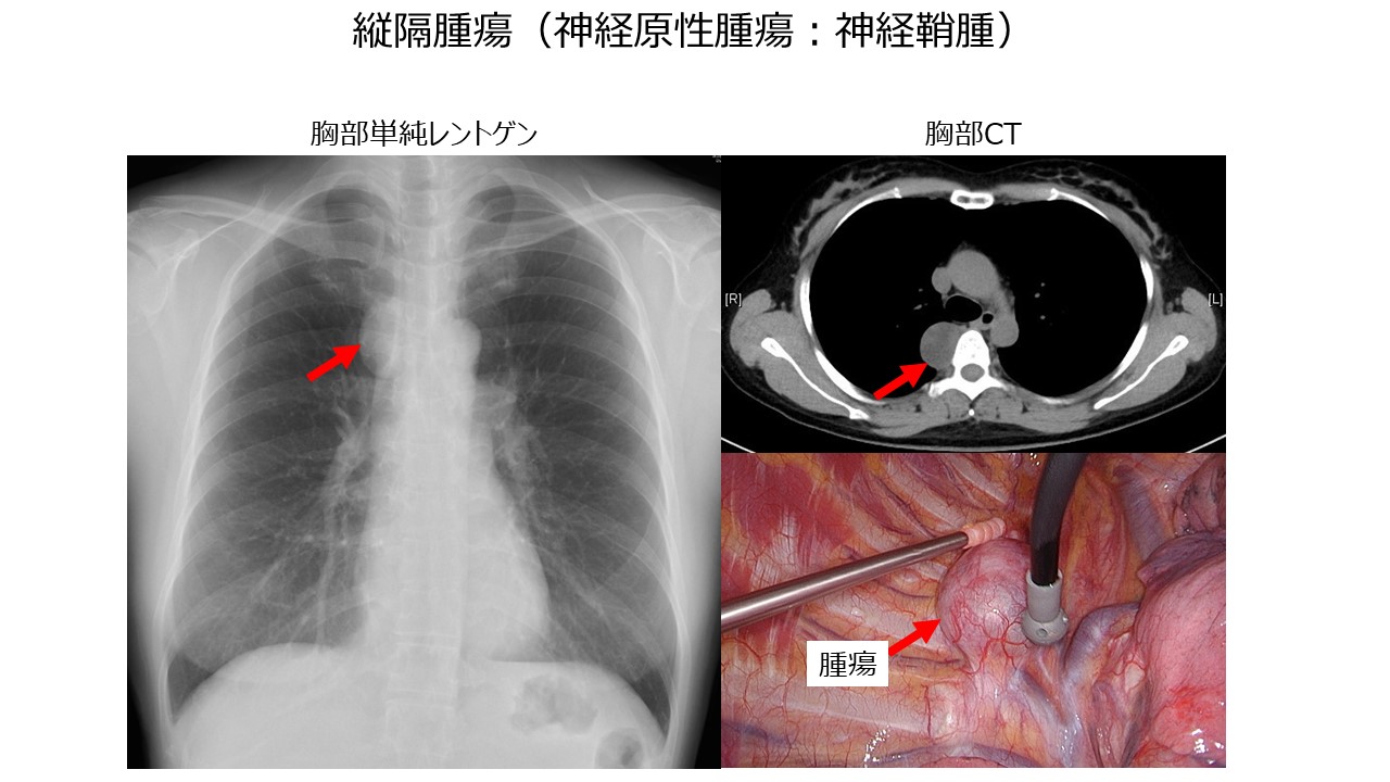 縦隔腫瘍（神経性腫瘍：神経鞘腫）