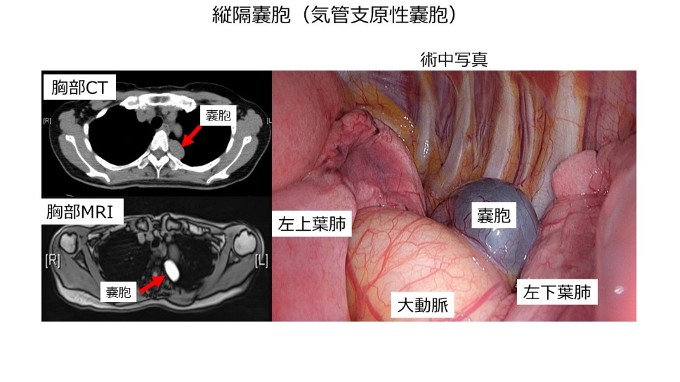 縦隔嚢胞（気管支原生嚢胞）