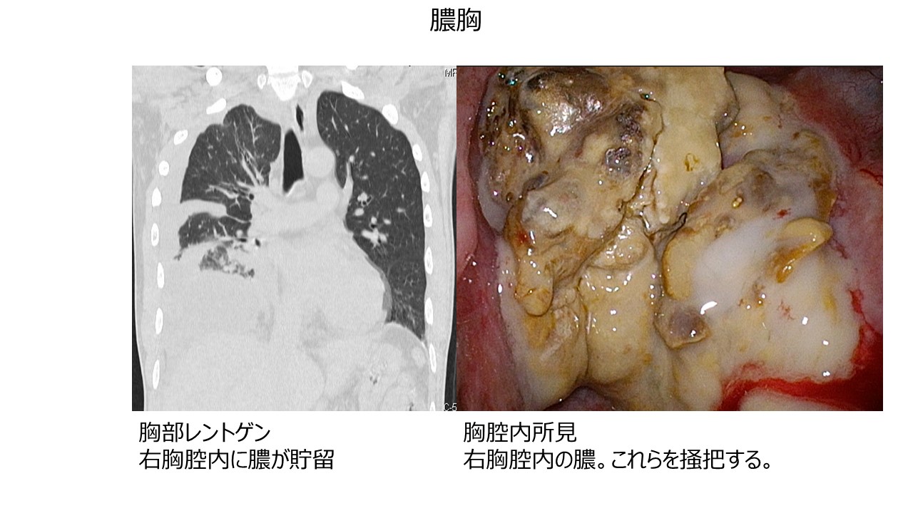 肺真菌症（肺アスペルギルス症）