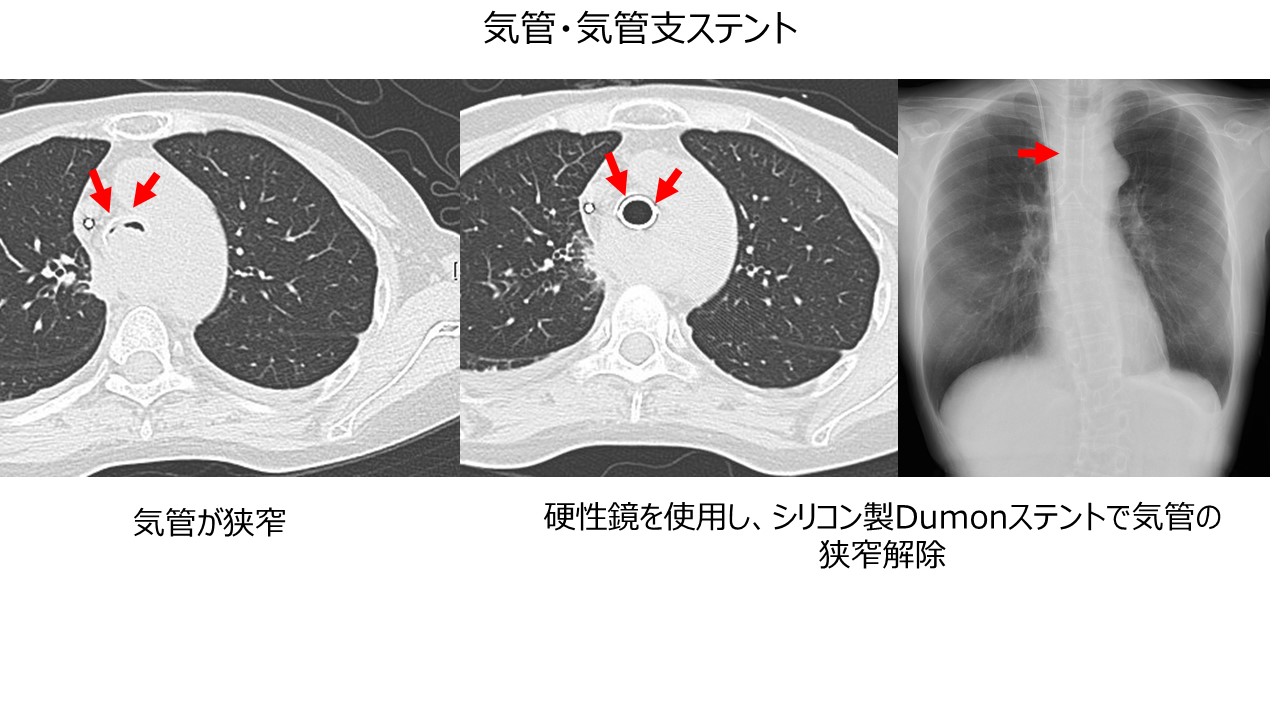 気管・気管支ステント