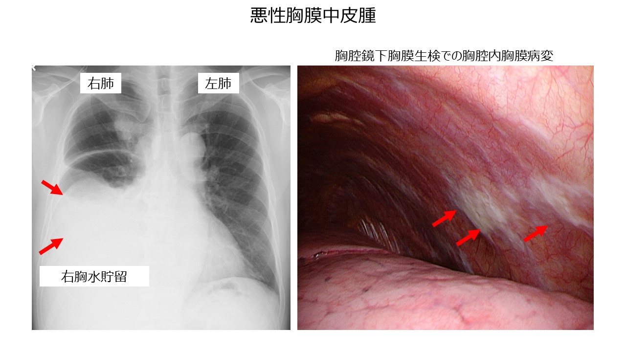 胸膜疾患 | 主な対象疾患 | 患者さん・ご家族の皆様 | 東京医科歯科 
